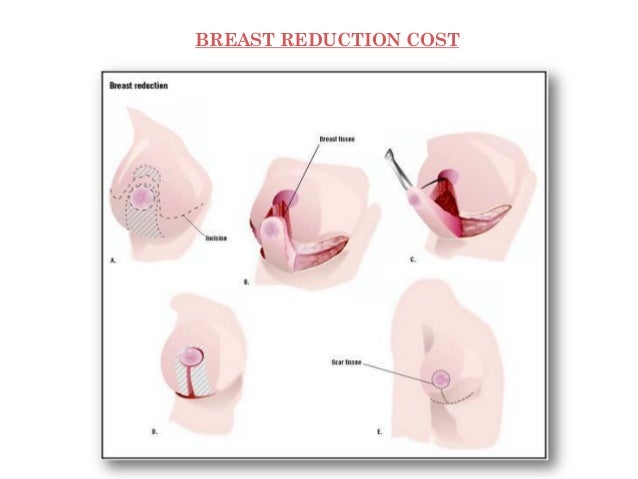 Boob job costs Fish hook and sex